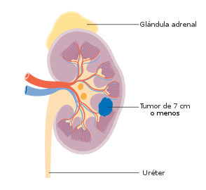 Cáncer de riñón en etapa 1
