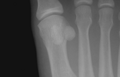 Sesamoid bones at the distal end of the first metatarsal.