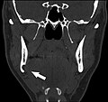 Stafne bone cavity seen on coronal CT