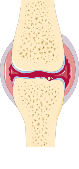 Description de l'image Osteoarthritis and rheumatoid arthritis - Rheumatoid arthritis -- Smart-Servier.png.