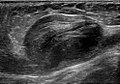 Ultrasonography of venous aneurysm