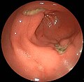 胃前庭部の多発胃潰瘍