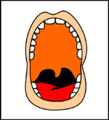 Pharyngeal_flap_procedures3.gif (18 times)