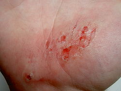 Abrasion on the palm of the hand