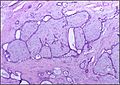 Histopathologic image of breast fibroadenoma showing proliferation of intralobular stroma compressing and distorting the epithelium. H&E stain.