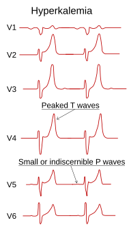 تخطيط كهربائية القلب showing تخطيط كهربائية القلبs in hyperkalemia.