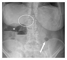 Plain abdominal radiograph showing Rigler's triad (pneumobilia indicated by the circle, ectopic gallstone indicated by the arrow, and bowel distension indicated by the asterisk).