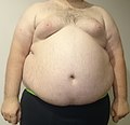 Striae distensae on an obese male