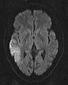 DWI showing cortical ribbon-like high signal consistent with diffusion restriction in a patient with known MELAS syndrome