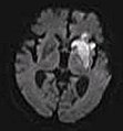 DWI showing necrosis (shown as brighter) in a cerebral infarction