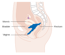 Stage IVA cervical cancer