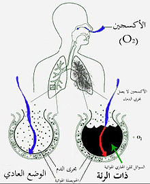 رسم تخطيطي للرئتي الإنسان ودائرة فارغة في الجهة اليسرى تمثل الحويصلات الهوائية الطبيعية وهو وأخرى على الجهة اليمنى تظهر حويصلة هوائية ممتلئة بالسوائل كما هو الحال عند حدوث ذات الرئة.