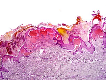 Scrotal angiokeratoma (Mibelli type); blood vessels close to the epidermis