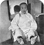 A Chinese woman shows the effects of foot binding on her feet.