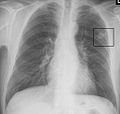 Lung nodule[16]