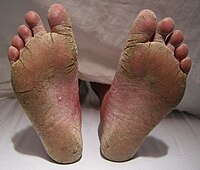 Tinea of feet