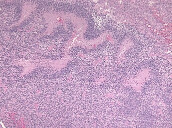 Pseudopalisades seen around necroses in glioblastoma.