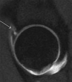 Sagittal T1 weighted image showing anterosuperior labral tear.[1]