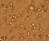 Bijele krvne stanice u urinu osobe s infekcijom mokraćnog sustava pod mikroskopom.