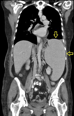 Description de l'image Splenomegalie bei CLL (labeled).jpg.