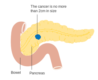 Stage T1 pancreatic cancer