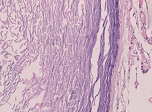 Histopathology showing epithelium and lamellated keratin (left)