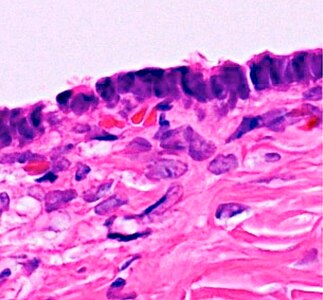 Histopathology of serous cystadenoma of the ovary, which is benign. It shows admixed scattered ciliated cells. This case closely resembles normal surface endometrial epithelium of the uterus.