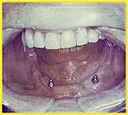 2 Implantate im Unterkiefer mit Patrizen zur Befestigung einer Cover-Denture-Prothese