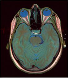 La neuro-imagerie a permis d’identifier les structures cérébrales impliquées dans la souffrance.