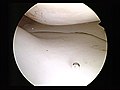 Normal medial meniscus