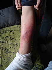 skin rash on the leg