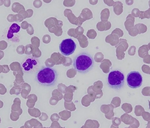 Tumour cells in peripheral blood smear