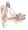 Illustration of the internal parts of a cochlear implant