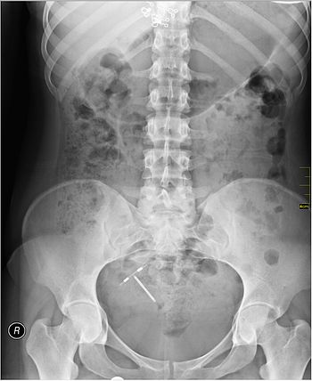 Intrauterine device on medical x-ray