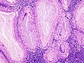 Histopathology of Warthin tumor in the parotid gland. Another view of a file "Warthin tumor (1).jpg". H&E stain.