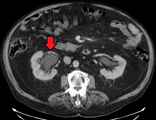 CT scan of bilateral hydronephrosis due to a bladder cancer