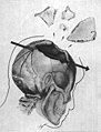 Trajectory of the missile through President Kennedy's skull. The bullet struck posterior part of his right parietal bone from behind.