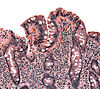 Biopsy of small bowel showing coeliac disease