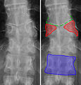 Butterfly vertebra (red). Normal vertebra for comparison (blue).