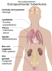 Huvudsymtomen vid pulmonell tuberkulos/lungtuberkulos (vänster) och de vanligaste organen som drabbas av sjukdomen utöver lungorna, det vill säga extrapulmonell tuberkulos (höger).