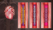 3D Medical Animation still shot of Percutaneous coronary intervention