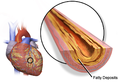 Fatty deposits causing coronary artery plaque