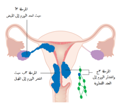 A diagram of stage III endometrial cancer