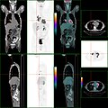 PET/CT of a staging exam of colon carcinoma. Besides the primary tumor a lot of lesions can be seen. On cursor position: lung nodule.