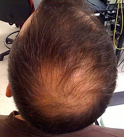 فقدان الشعر لدى رجل يبلغ عمره 33 سنة.