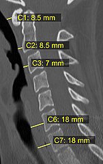 CT scan with upper limits of the thickness of the prevertebral space at different levels.[8]