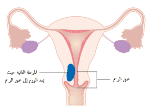 A diagram of stage II endometrial cancer