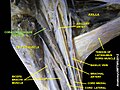 Coracobrachialis muscle (shown in green text)