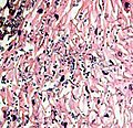 H&E stain of esophagus showing Candida hyphae within the lamina propria