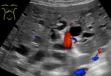 Also dilated intrahepatic bile ducts. They are colorless (black) in contrast to blood vessels (portal vein near center, and hepatic artery to the right of it) which have Doppler signal.